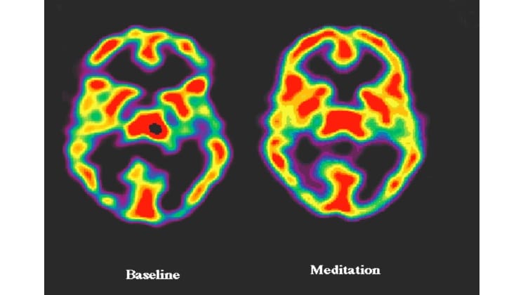 scanner d'un cerveau sous méditation et Yoga Nidra - Nida Rest